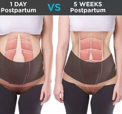 diastasis rectus abdominis physical therapy in DHA lahore