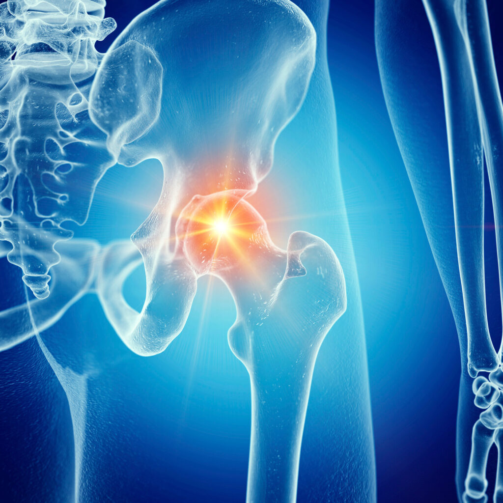 Illustration of a painful hip joint.